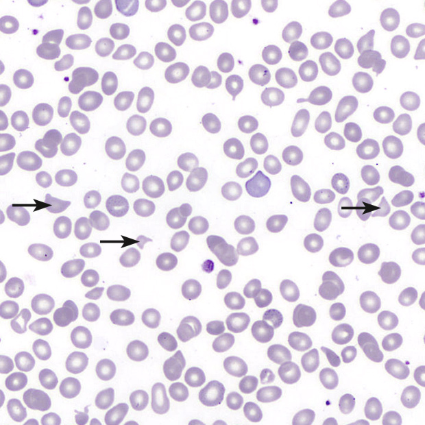 hematology_scientificmedia_fragmented_red_blood_cells_microscope_image